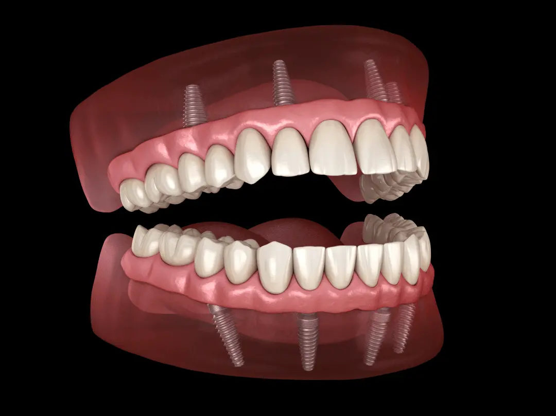 All On Four Implants Malatya